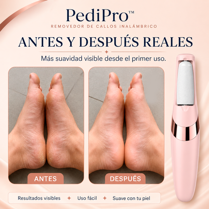 PediPro™ | Removedor de Callos Inalámbrico | Mostrá Tus Pies Sin Vergüenza